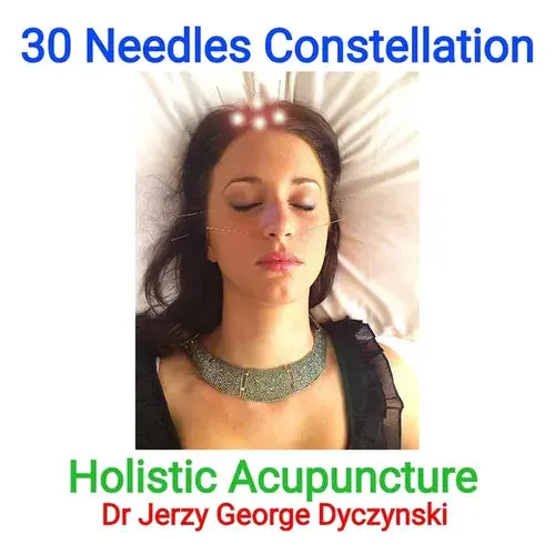 30 Needles Constellation Acupuncture: Holistic Acupuncture - Paperback 1